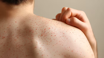 Alerta por el sarampión: advierten sobre el riesgo de nuevos brotes en Argentina y refuerzan la importancia de la vacunación